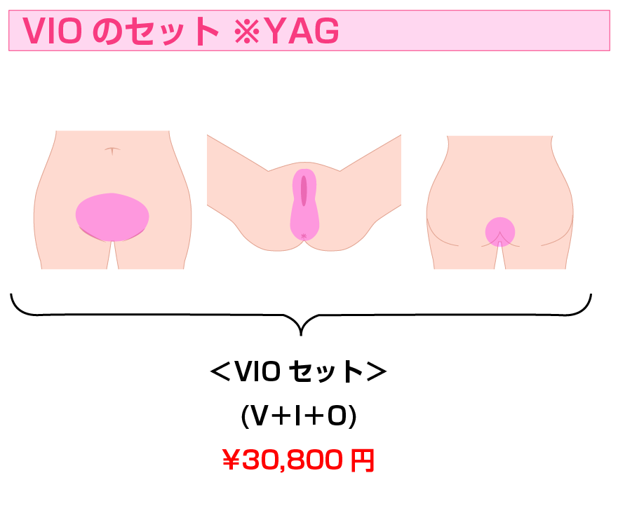 VIO全体と一部 | 医療レーザー脱毛