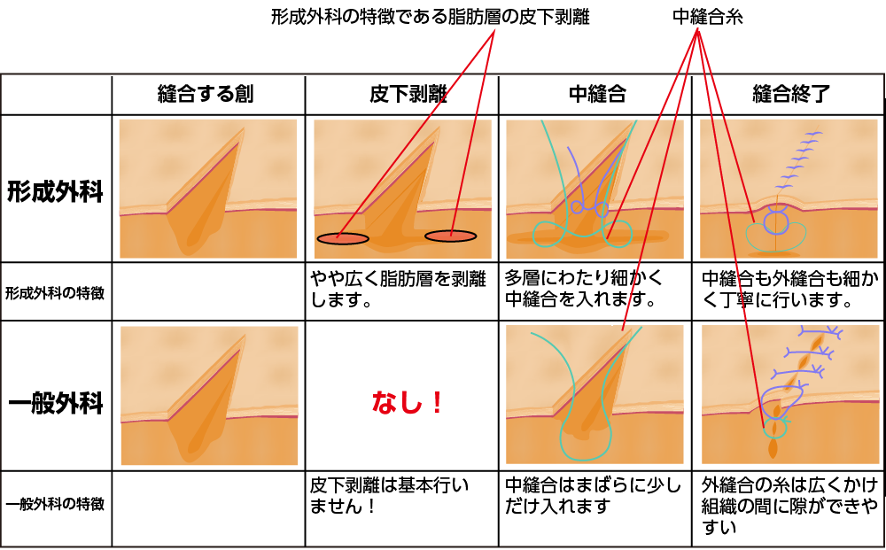 形成外科と一般外科の縫合技術の違い