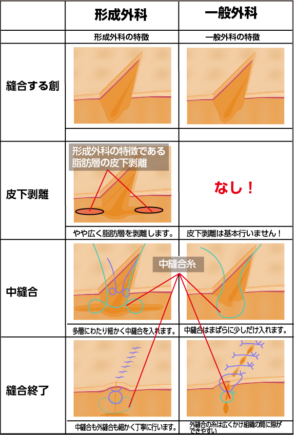 形成外科と一般外科の縫合技術の違い