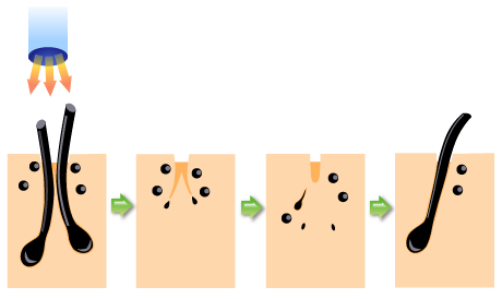 毛周期に合わせて脱毛する図2