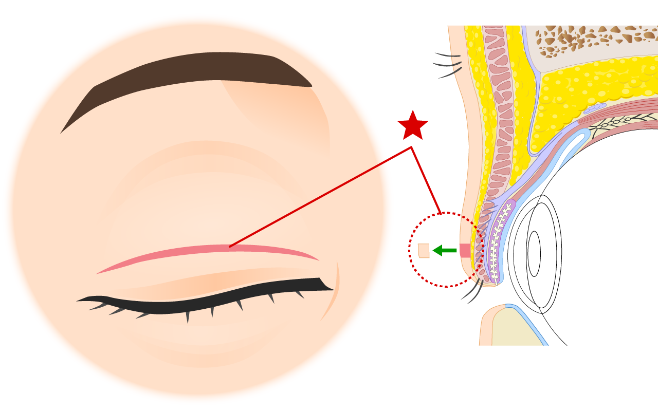 少し皮膚を切除しながら二重まぶたを作ってみます