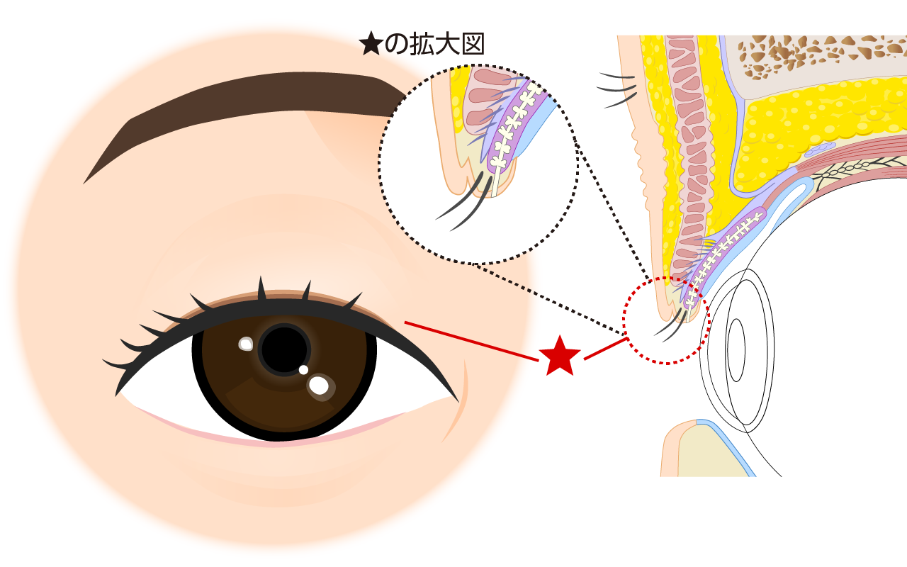 少し皮膚を切除しながら二重まぶたを作ってみます