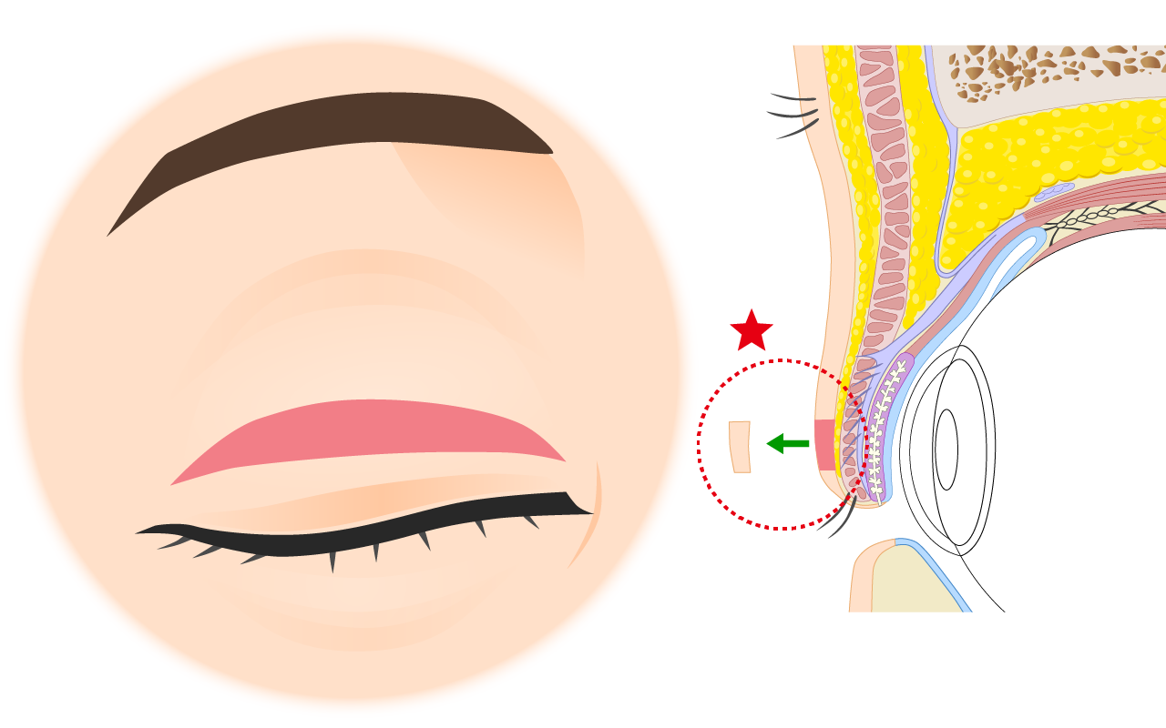 二重幅を少し大きくするため上眼瞼の皮膚を多めに切除