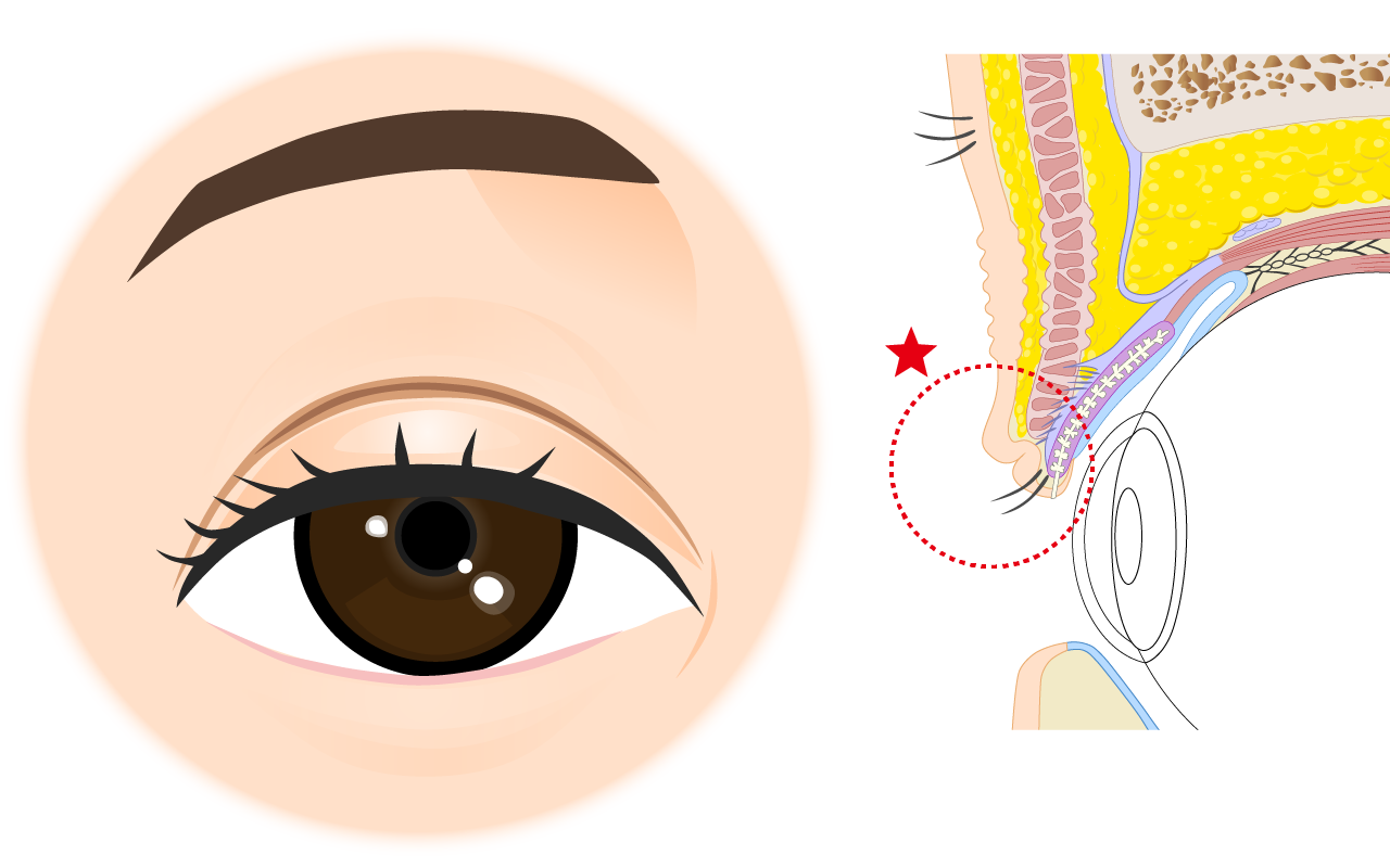 二重幅を少し大きくするため上眼瞼の皮膚を多めに切除