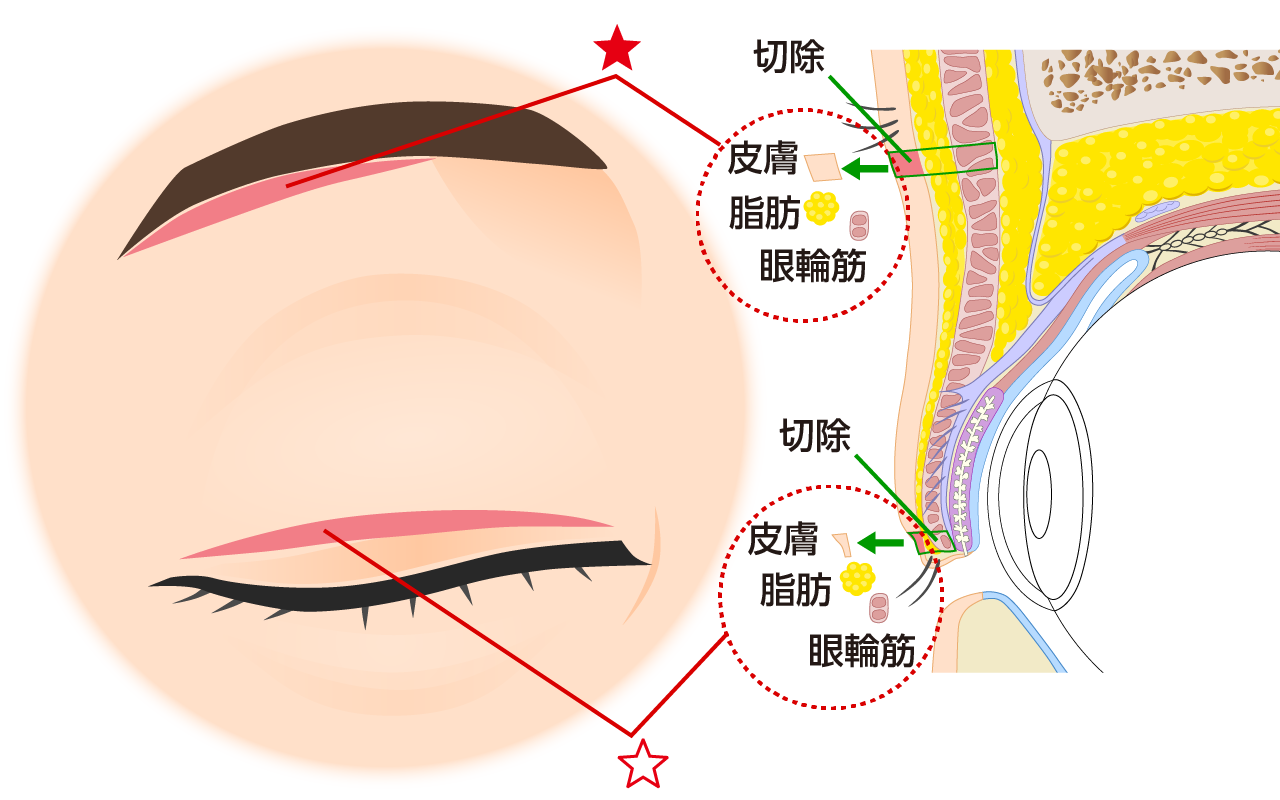 重瞼線を皮膚の薄いところで作ると