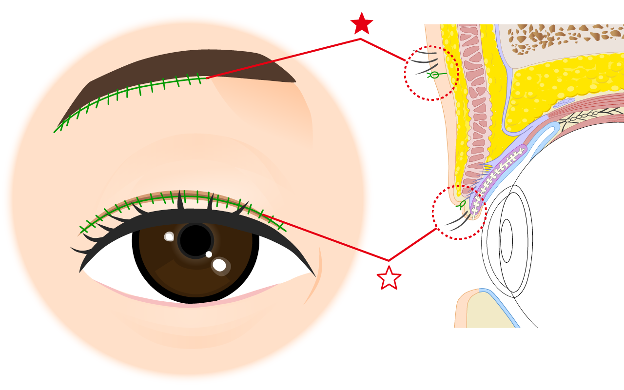 重瞼線を皮膚の薄いところで作ると