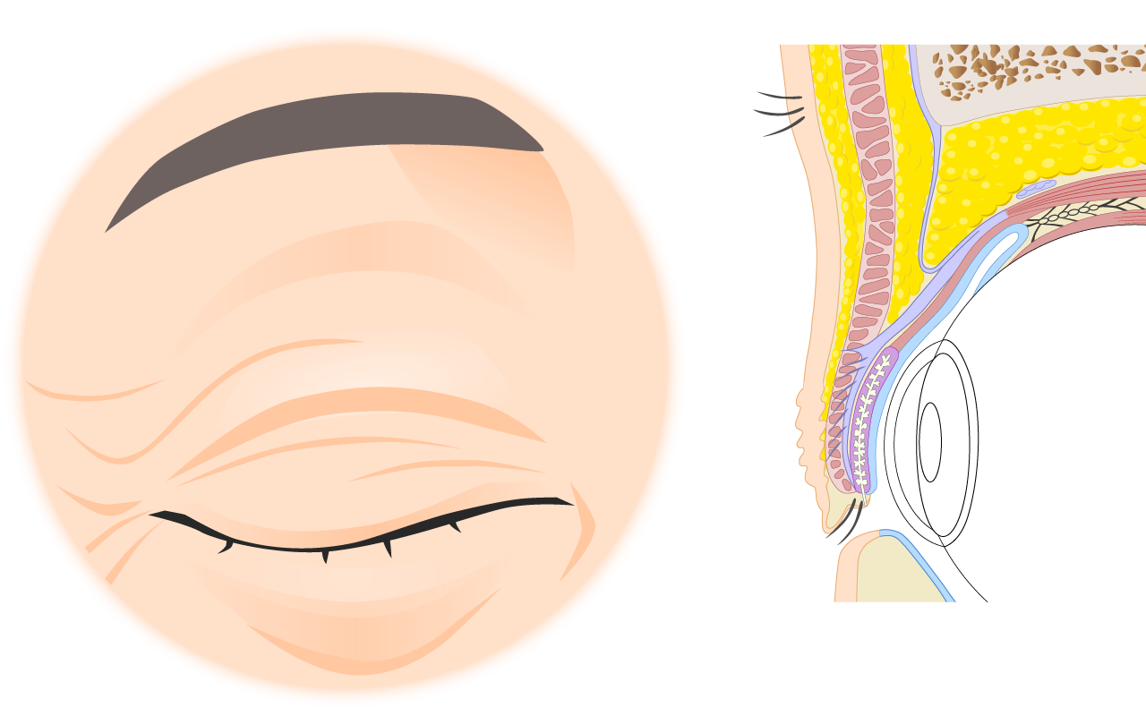 加齢者（お年寄り）の弛んだ上眼瞼