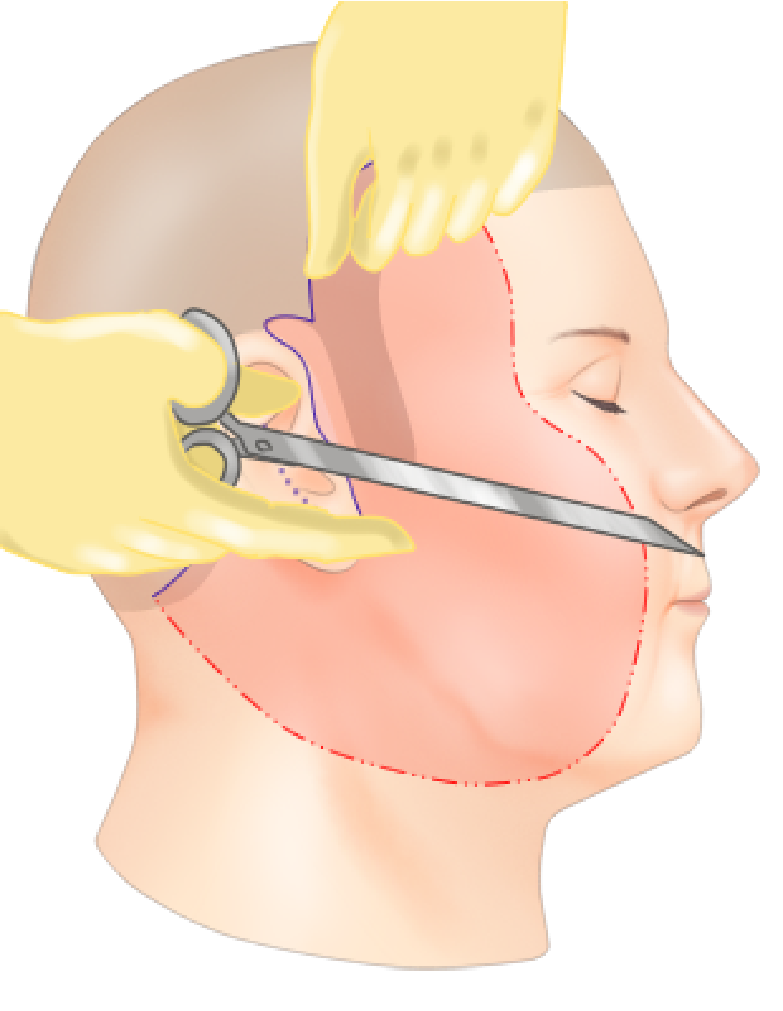 フェイスリフトの手術模式図